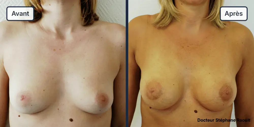 Augmentation mammaire à Saint-Tropez Patient 1 - Face - Dr Stéphane Raoult