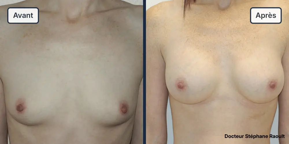 Augmentation mammaire à Saint-Tropez Patient 2 - Face - Dr Stéphane Raoult