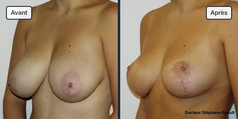 Lifting des seins à Saint-Tropez Patient 1 - 3/4 Gauche - Dr Stéphane Raoult