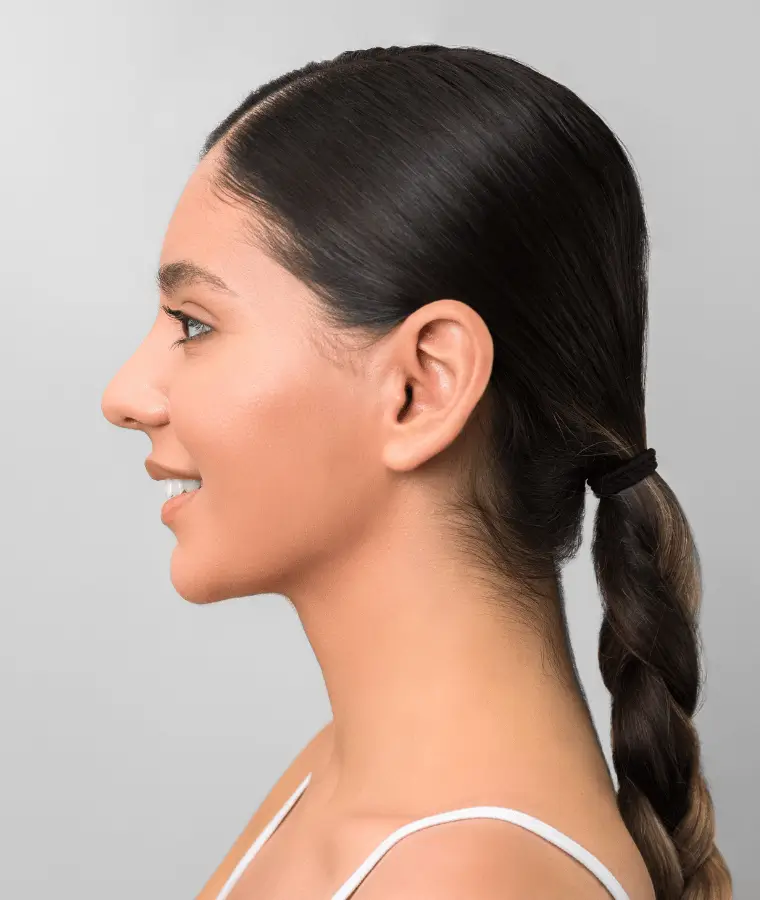 Otoplastie oreilles décollées profil harmonieux - Dr Stéphane Raoult chirurgien esthétique